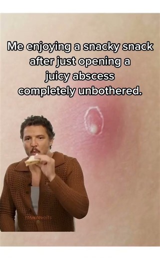 #CapCut #abscess #abscesslancing #abscessdraining #abscesses #pediatrics #doctor #doctorsoftiktok