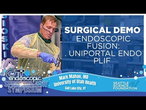 Surgical Demo: Endoscopic Fusion - Uniportal Endo PLIF - Mark Mahan, M.D.