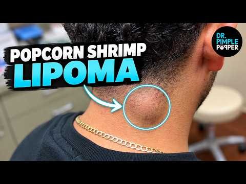 Dr. Pimple Popper vs. The Popcorn Shrimp Lipoma