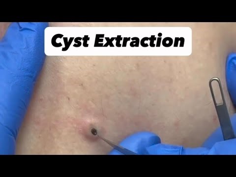 Cyst Extraction