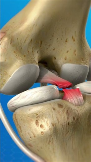 PCL Reconstruction & Meniscus Repair | Complete Knee Surgery