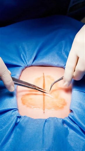 Deep Blackhead Removed From Ear #pimpleextraction #deepcleaning #beauty