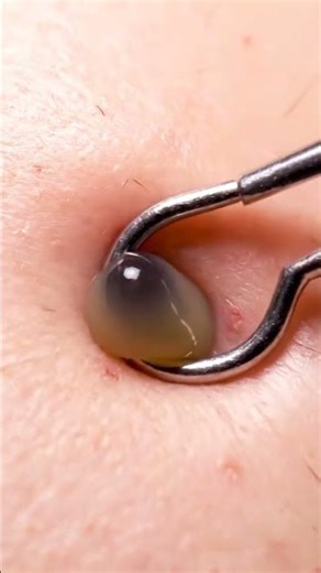 Deep Cystic Acne Treatment #cysticacne #skintreatment #beautyhack