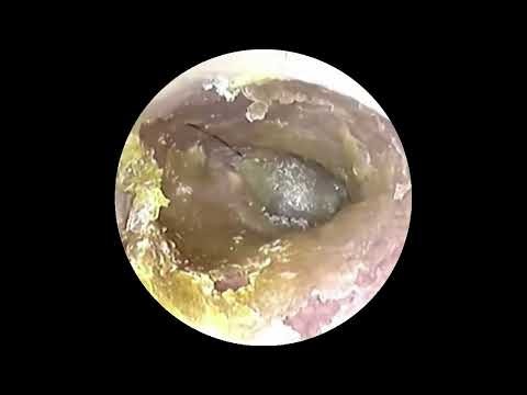 Satisfying Ear Wax Removal – Chill & Relax Part 128