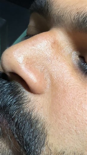 Akshay verma on Instagram: "Nose black head remove #blackhead #blackheadextraction Blackheads themselves are generally harmless but can lead to issues like enlarged pores, uneven skin texture, inflammation, and potential scarring if picked at; untreated, they can develop into more severe inflamed acne (pimples/cysts), causing pain, redness, and sometimes post-inflammatory hyperpigmentation (dark spots) or permanent scars from improper extraction. The main “side effects” come from managing them p