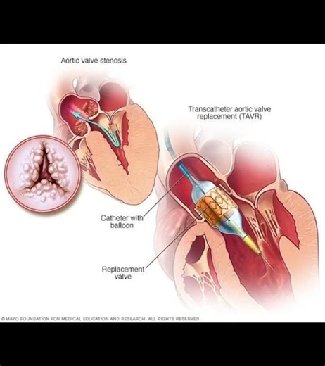 Aortic valve replacement without open heart surgery! #Shorts