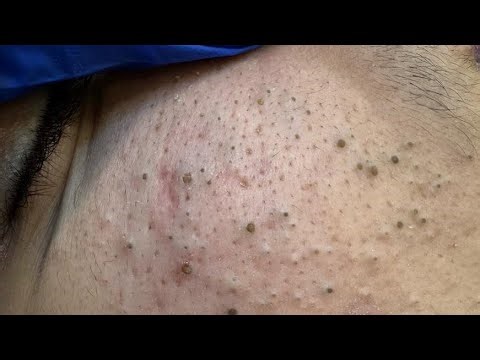 Blackheads Getting Worse? | Here's Your Daily Solution