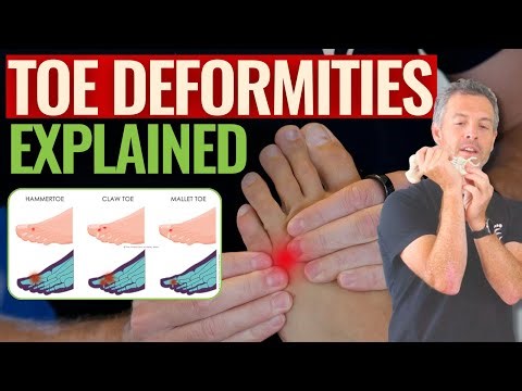Toe Deformities: What’s Really Going On? | Podiatrist Andy Bryant Explains