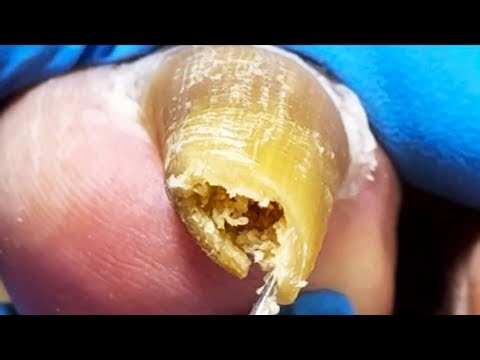 Roll The Onychomycosis Into A Circle To Remove Impurities!【Xue Yidao】