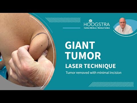 Giant tumor removed through a minimal laser incision - 25210