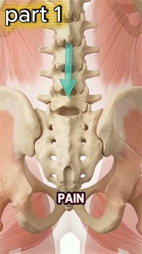 DEEP ONE-SIDED LOW-BACK PAIN MAY NOT BE JUST A MUSCLE STRAIN.
