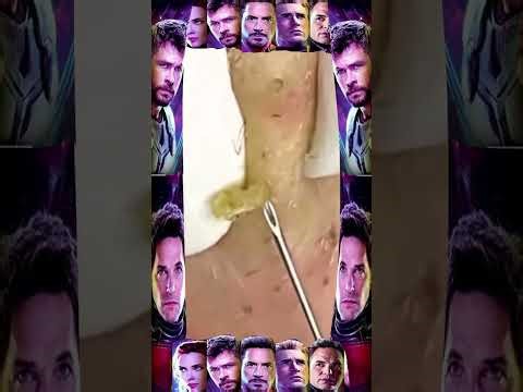 Blackheads Removal #361 | Acne Treatment and Very Satisfying Satisfying Pimple pop #blackheads