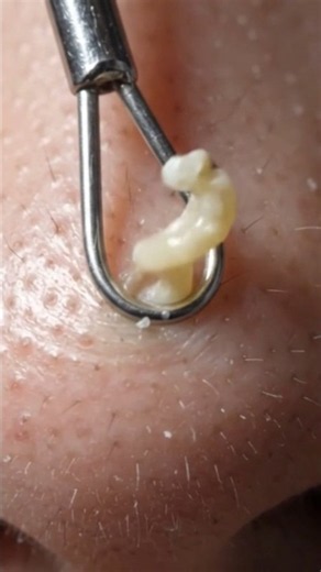 Oddly Satisfying Blackhead Removal ✨