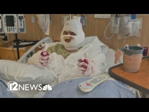 2 men severely burned in gas line explosion