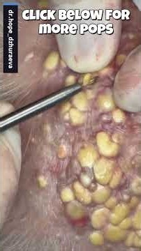 Extreme Seattle Tacomas!😳 #blackheads #pimplepopping #satisfying #shortsfeed #viralvideos