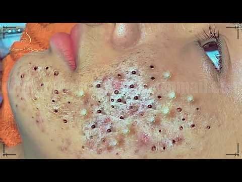 Best Satisfying Pimples Popping Cyst Removal Acne Blackheads #1254