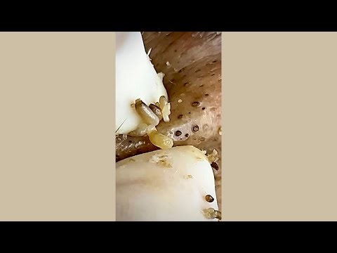 Skincare | Blackheads Removal #667 #tweezers skincare #blackheads blackheads