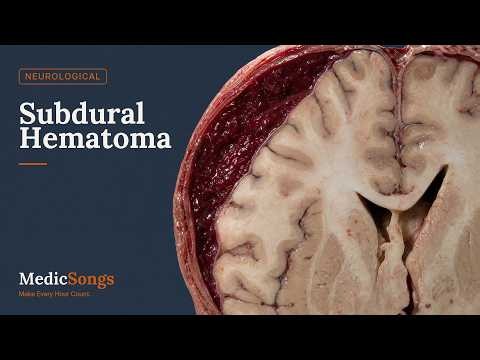 Subdural Hematoma | USMLE Step 1