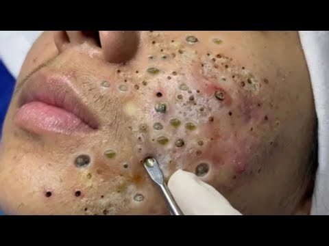 Deep blackhead Removal 2026, acne removal spa, big pimple 2026, #acne #pimple #cyst