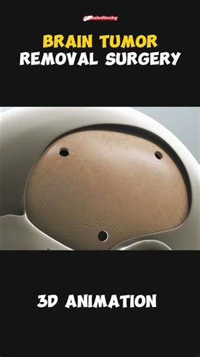 brain tumor removal surgery #medicalshorts #surgery