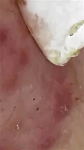 Blackhead Removal Videos Ever | VET Spa 4K #009