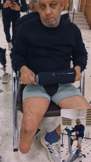 From Amputation to Freedom | Below Knee Prosthetic Leg Restores Cycling & Walking Independence