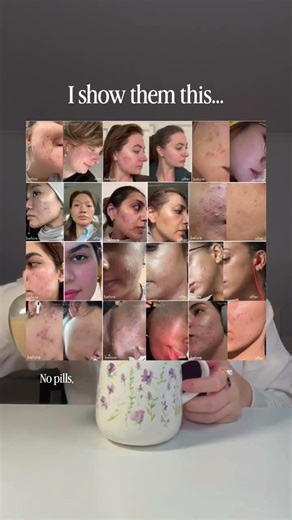 No Accutane. No birth control. No pills. No 10 step routines. And absolutely no diet.