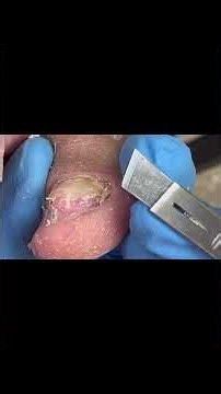 The secret to removing stubborn ingrown toenails