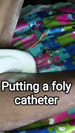 putting a foly catheter #aimms #hospital #doctor #trending #reels