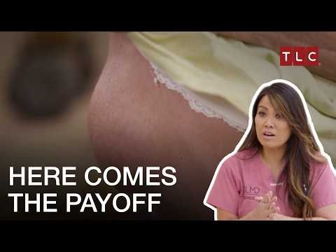 Watch Dr. Lee Tackle These Stubborn Cysts And Bumps | Dr. Pimple Popper S3 | TLC India
