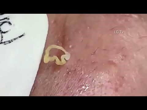 Deep Acne Extraction Compilation 2026 | Satisfying Pimple Popping Videos