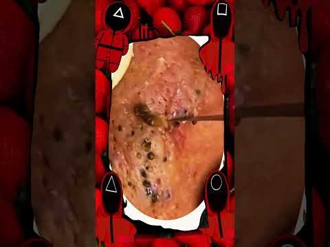 Satisfying self-cleaning of blackheads Acne Treatment Pimple pop