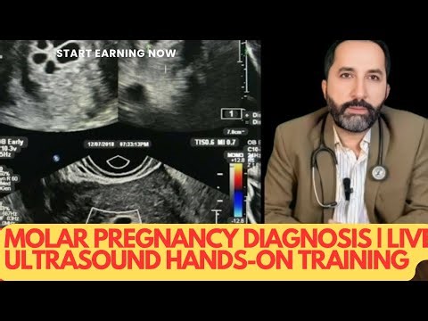 Molar Pregnancy Diagnosis | Live Ultrasound Hands-On Training