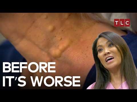 A Surgery That Could Change Her Face Forever | Dr Pimple Popper S2 E7 | TLC India