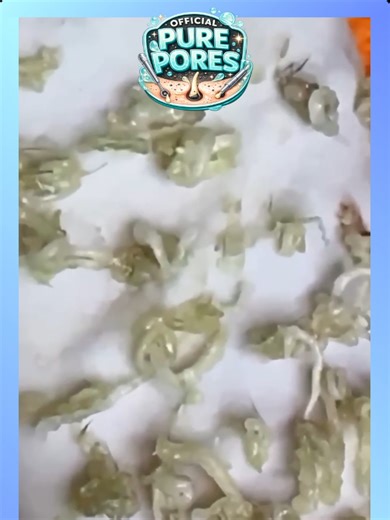 #18 - Shorts4 - Official Pure Pores Skin Care React to Soothing facial treatments ASMR @officialpurepores #blackheadremoval #acneextraction Voice reaction and animations to Extreme blackhead removal, deep pore cleansing, intense acne extraction and satisfying skincare close-ups captured in HD and 4K macro detail. This video features real pimple popping, whitehead extraction, nose pore cleaning and deep skin cleansing designed to be relaxing and oddly satisfying. Watch clogged pores transform thr