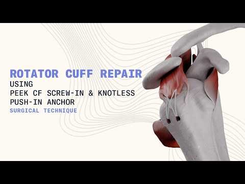 Rotator Cuff Repair Technique | PEEK CF Screw-In Suture Anchor & PEEK CF Knotless Push-In Anchor