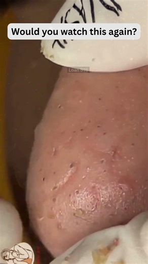 🔥Deep Blackheads, Milia & Whitehead Removal pimple popping New| Big Cystic Acne Extraction#1277 2026