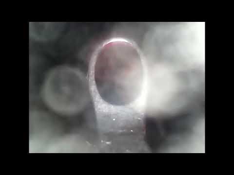 Pimple Popping - Ultimate Pimple Popping Compilation#97