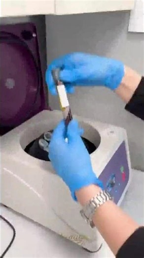 🌟PRF (Platelet-Rich Fibrin) is a natural platelet concentrate that promotes healing and regeneration