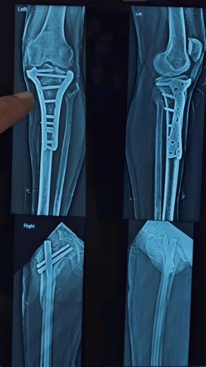 Tibia proximal and Femur bone fracture treatment | Full knee moment