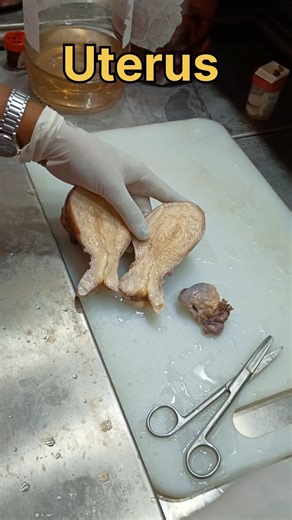 Uterus specimen cutting and fixation| #histopathology #histomuseum #cervicalcancer #uterineprolapse