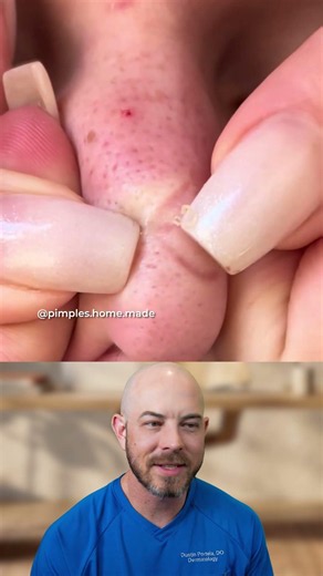 Homemade Pimple Popping with Long Nails #skincare #pimples