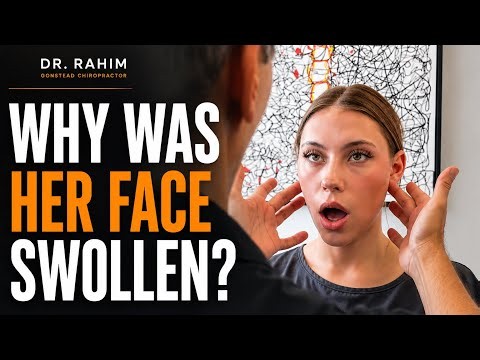 CAR ACCIDENT Left Her With Neck Pain, Headaches & Facial Swelling 😳
