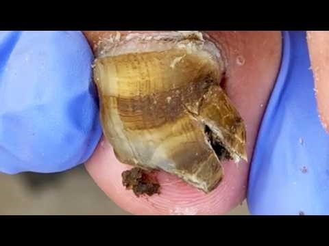 So Amazing, Black Toenails, Clean And Trim Them In Time【Dr Liu's Pedicur】