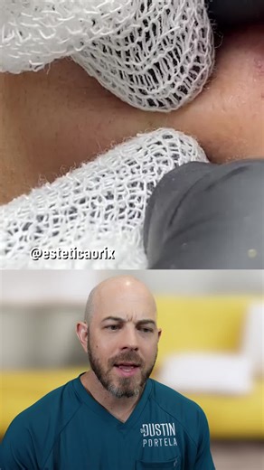 These Aren’t Just Sebaceous Filaments — Watch the Blackheads Pop.... #dermatologistreacts #dermatologist