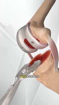 Knee Replacement Surgery Explained! 🇱🇷 🦵 Would You Do It?