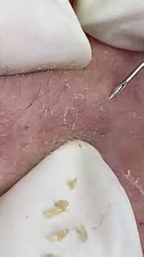 Relax and watch this satisfying acne and blackhead extraction video. #0001 #Pimple #acne #blackhead
