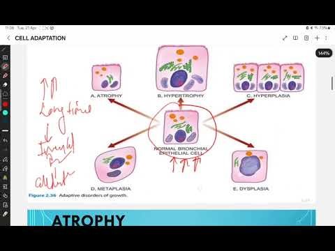 Cell adaptation,cell injury,basic pathology
