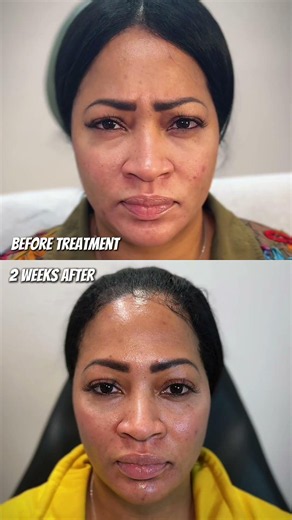 ✅ 💉 Dysport Results in Just 2 Weeks - Rahma Scott, PA-C | West End Plastic Surgery