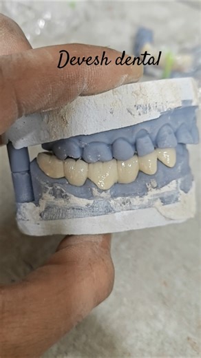 CAD/CAM dental bridge uses Computer-Aided Design (CAD) and Computer-Aided